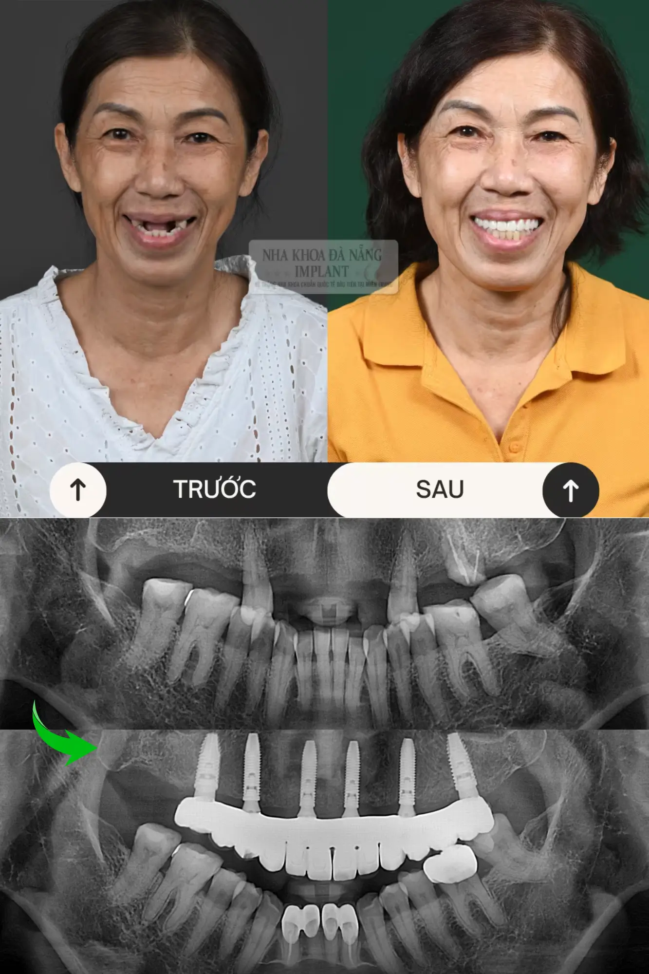 5 Đặc tính của dòng trụ Implant Nobel Biocare - Giải pháp phục hình răng được đông đảo khách hàng lựa chọn 19 Khách hàng Lê Thị Tình