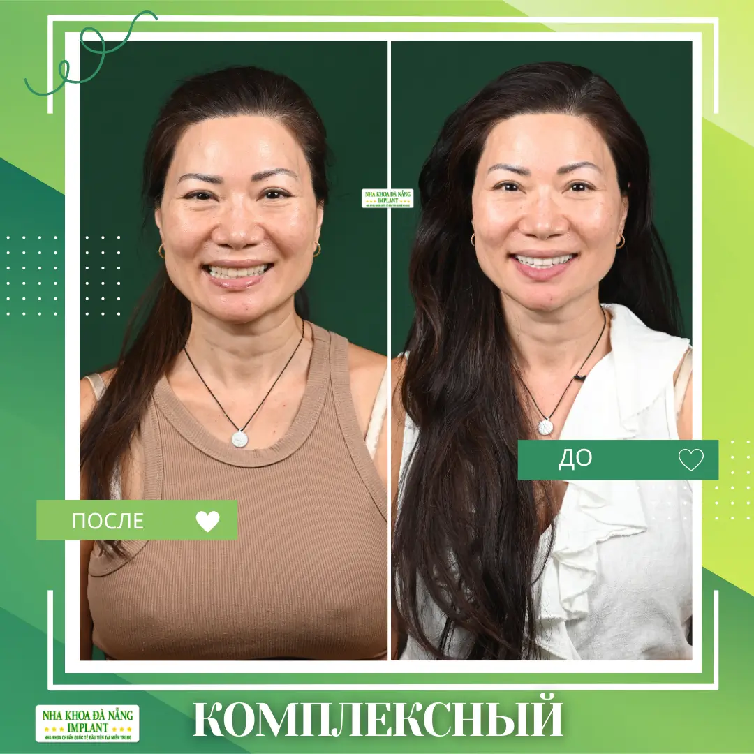 Фотографии после установки коронок