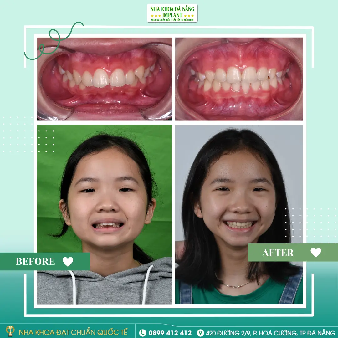 Mai Ha My – 11 years old