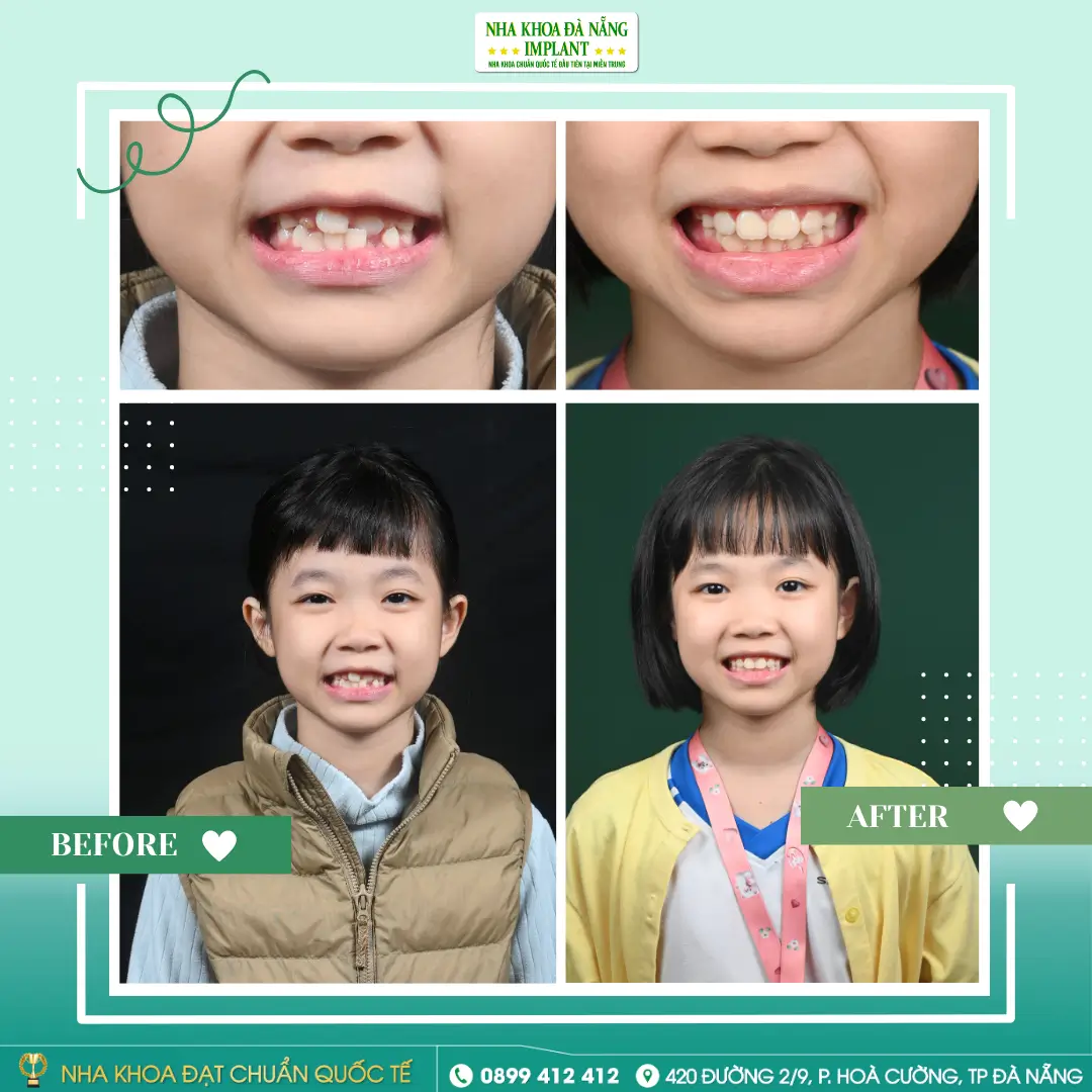 Case 2: Moc Mien – 8 years old