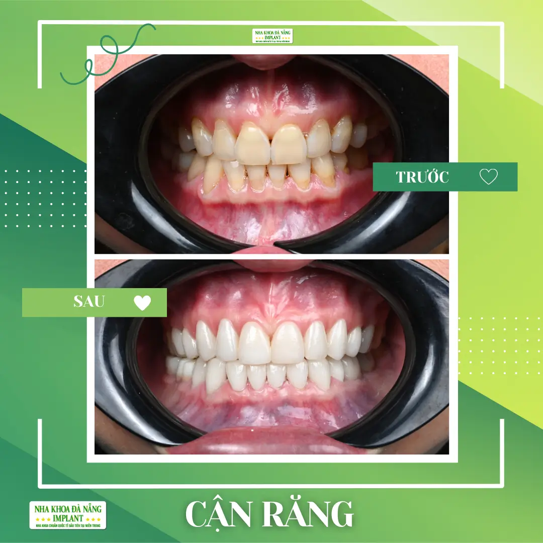 Hình trước khi bọc sứ