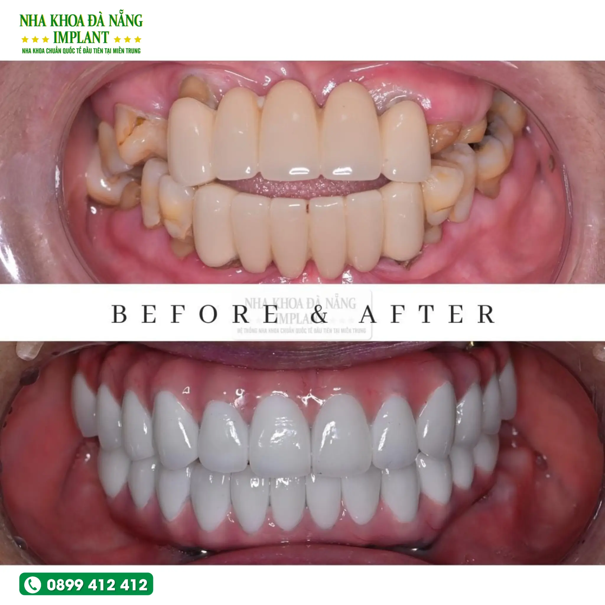 5 Characteristics of Nobel Biocare Implant – A tooth restoration solution widely chosen by customers 14 The transformation achieved with Nobel Biocare Implant placement