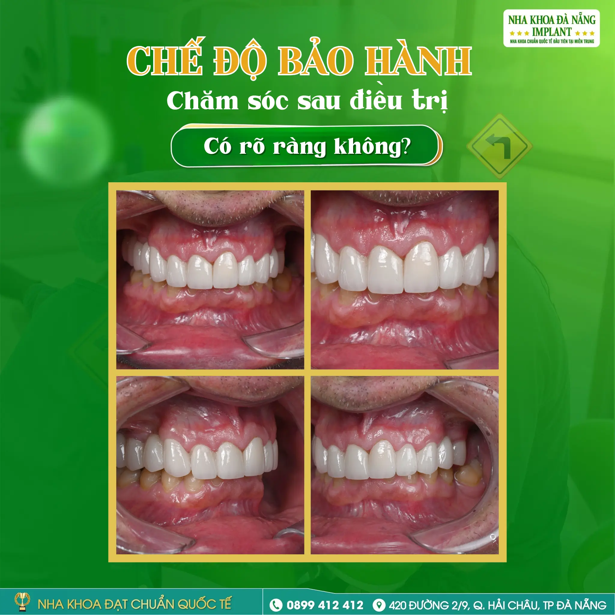 Đừng vội bọc răng sứ nếu bạn chưa biết 5 điều này 13 Đừng vội bọc răng sứ nếu bạn chưa biết 5 điều này