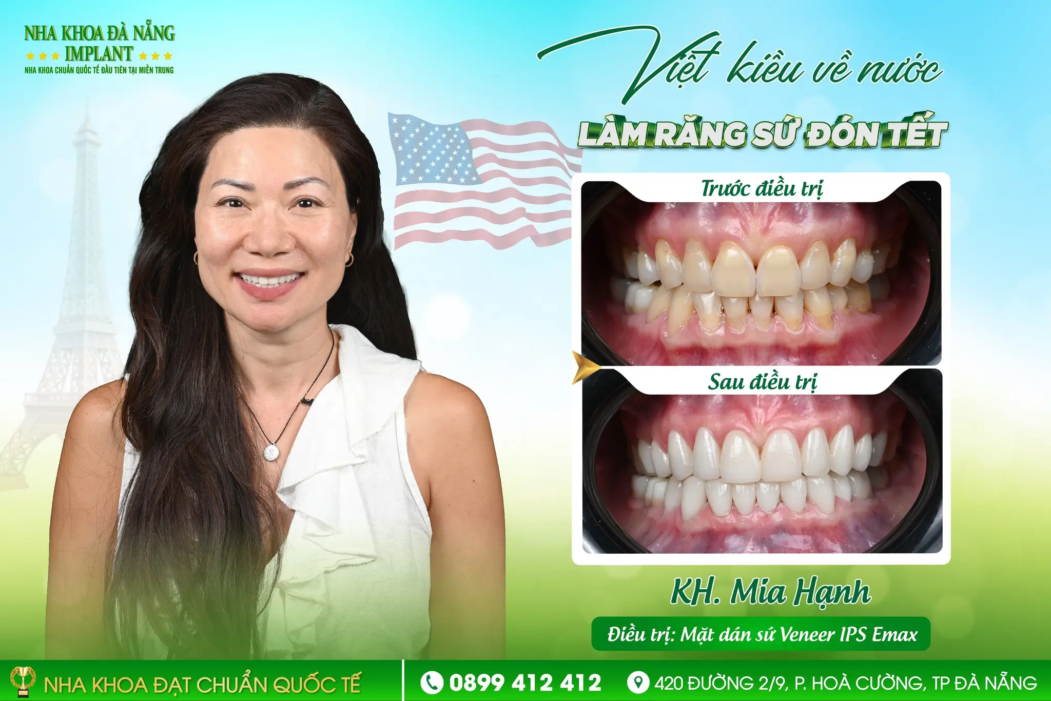 Case Việt Kiều làm răng sứ trước Tết: Phân tích toàn bộ quy trình – công nghệ – kết quả