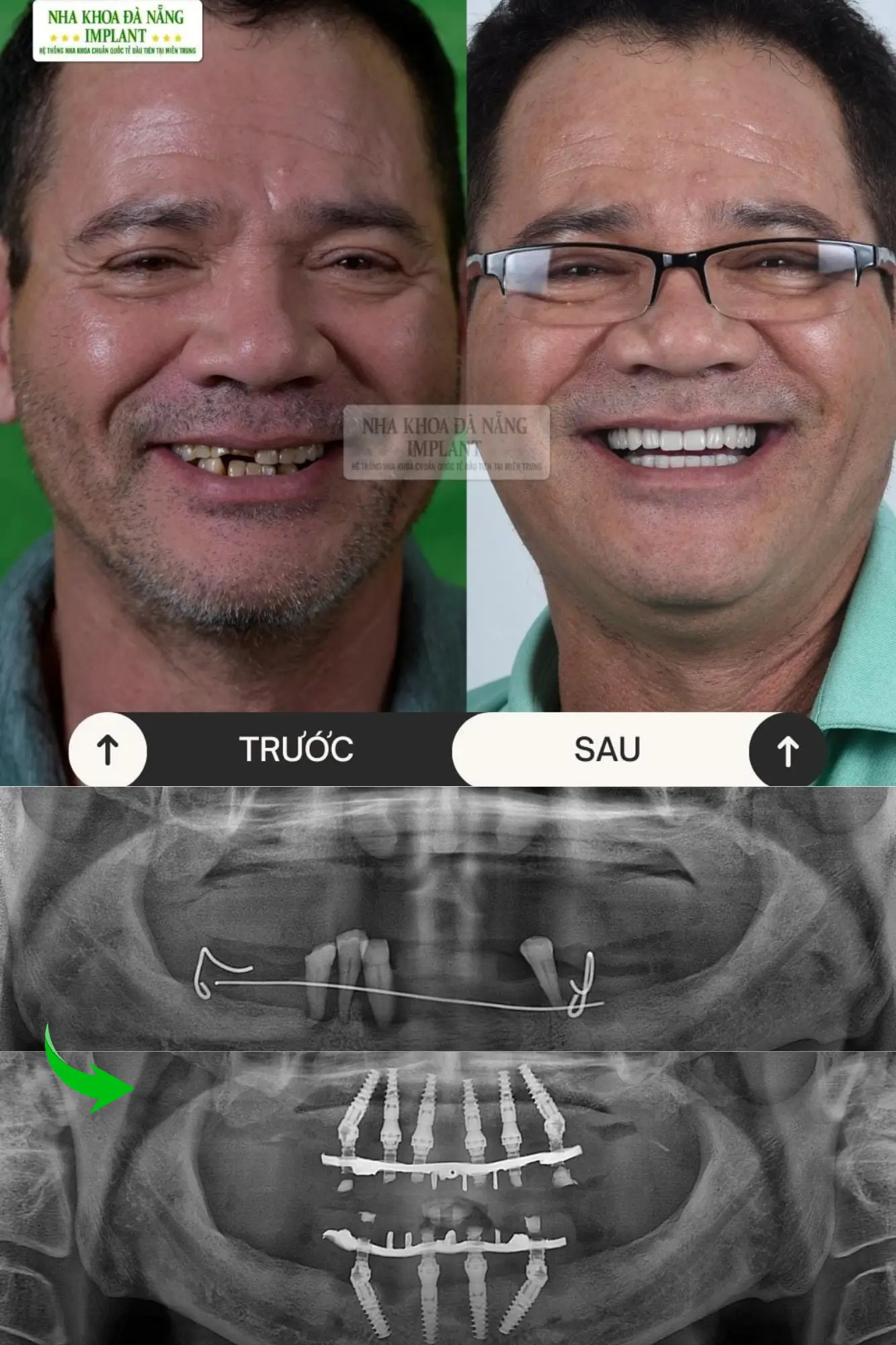 5 Đặc tính của dòng trụ Implant Nobel Biocare - Giải pháp phục hình răng được đông đảo khách hàng lựa chọn 18 Khách hàng Dương Bình