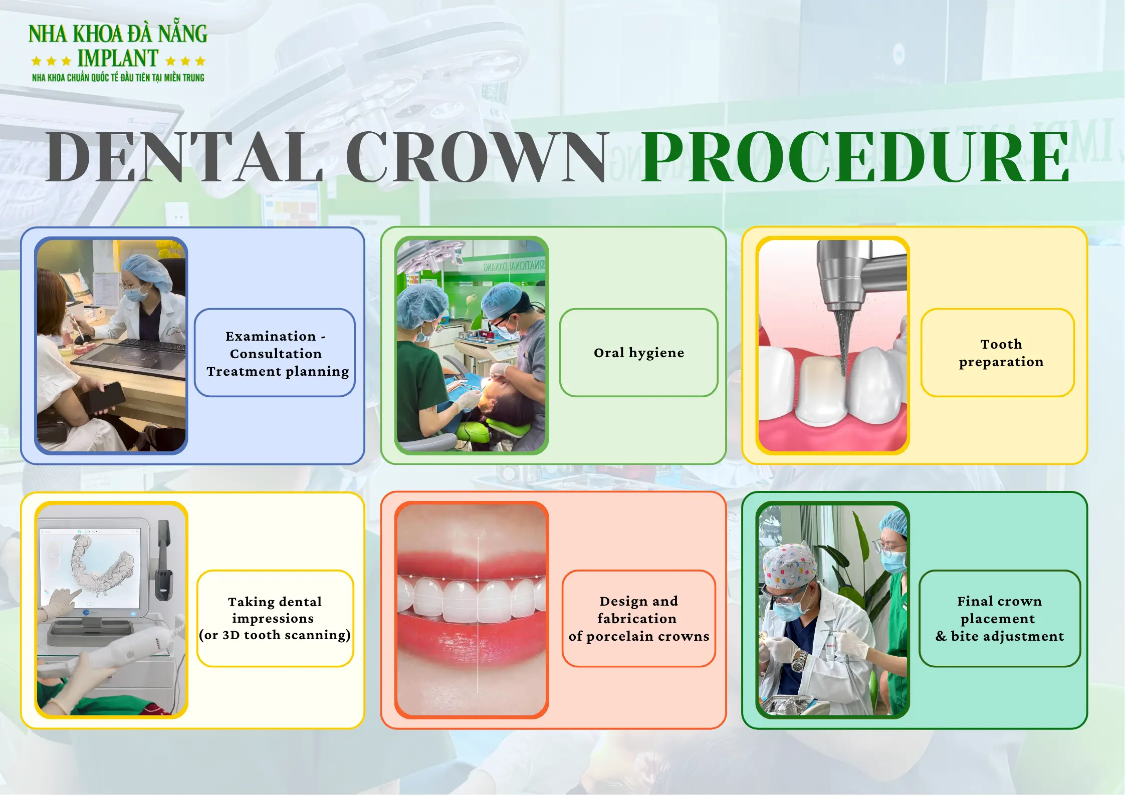 Porcelain Crown Procedure at Da Nang Implant Dental Clinic