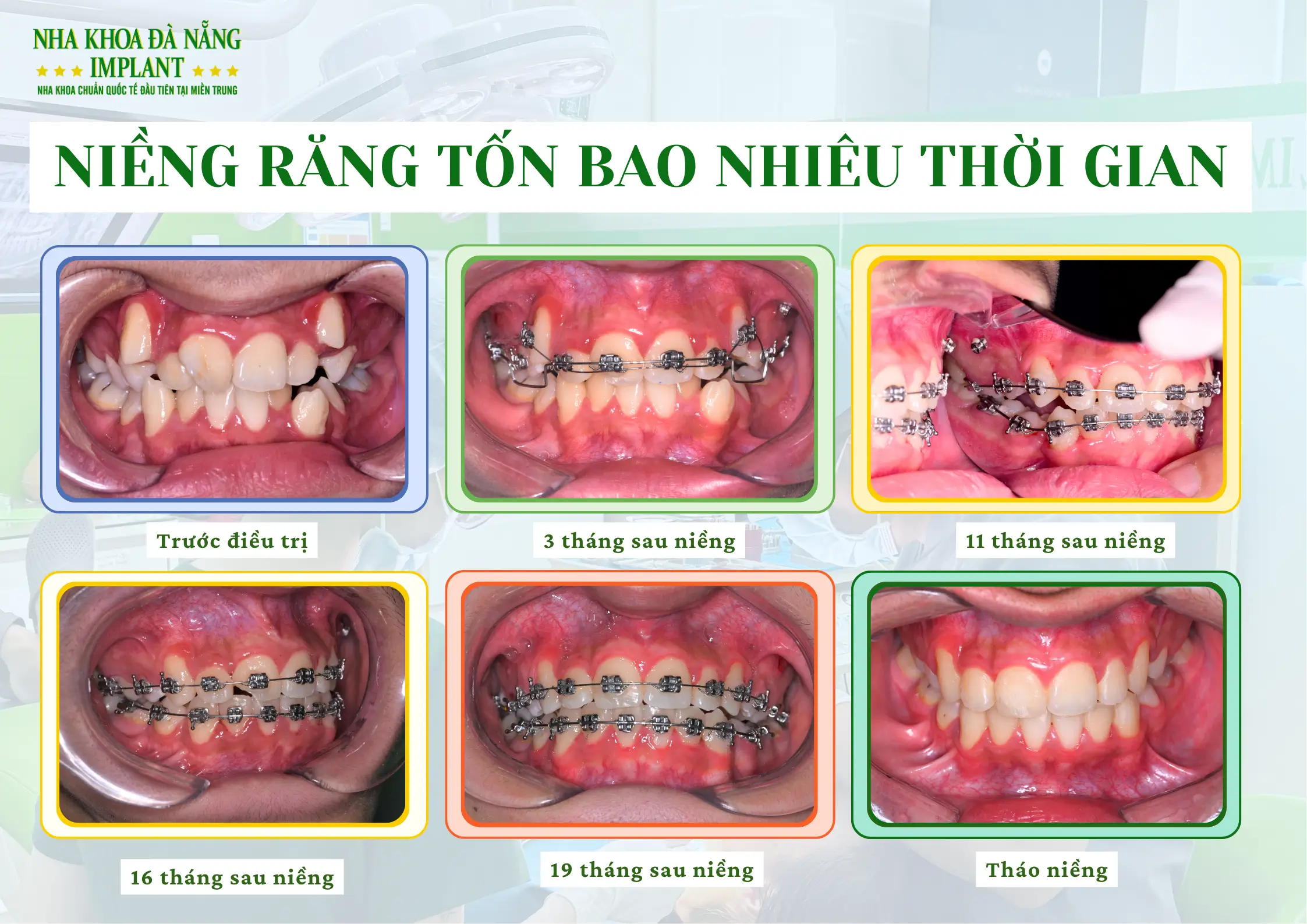 Niềng răng tốn bao nhiêu thời gian