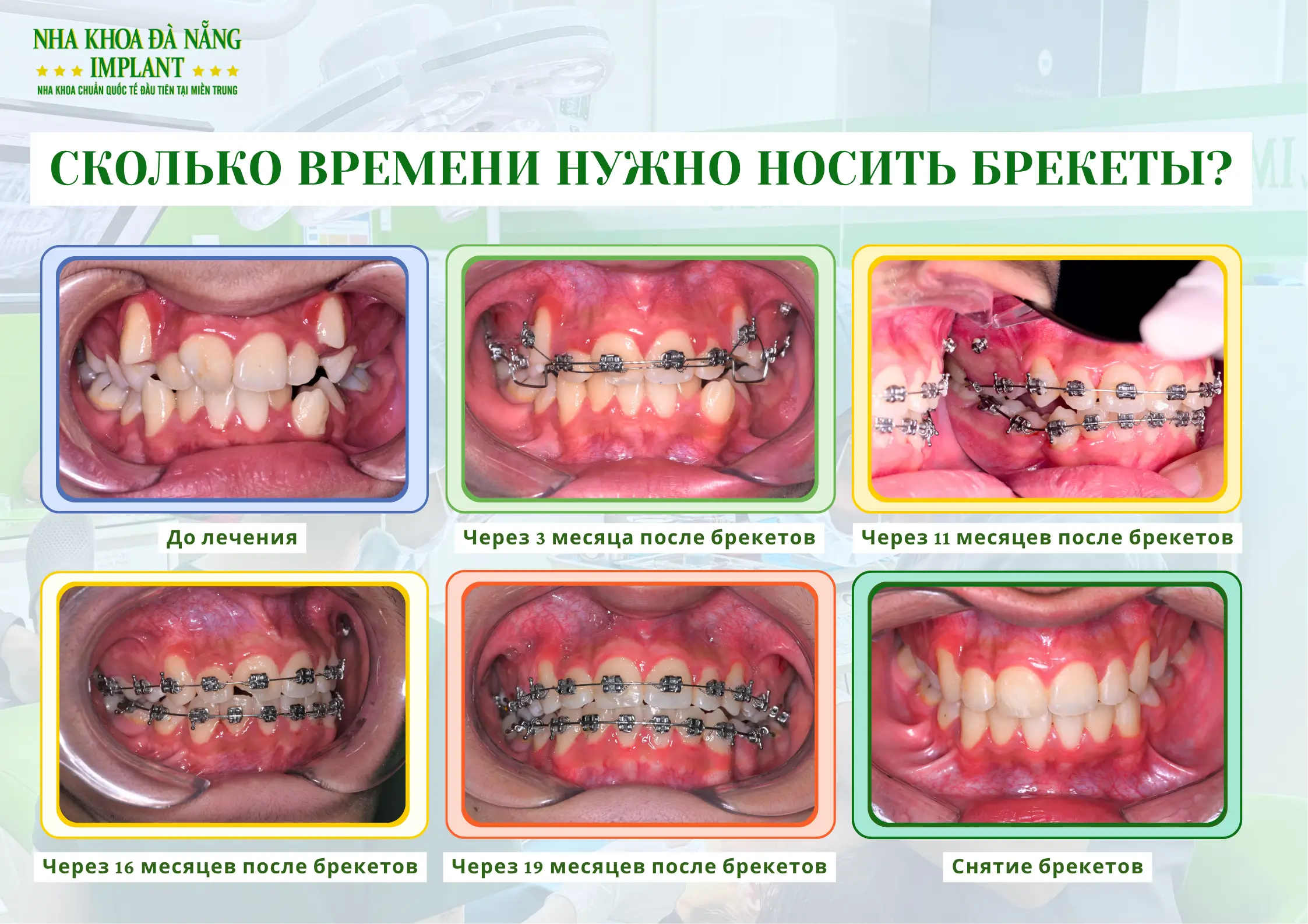 5 Самых Больших Страхов При Ношении Брекетов – Как Врачи Помогают Вам Их Преодолеть 8 Сколько времени занимает лечение брекетами?