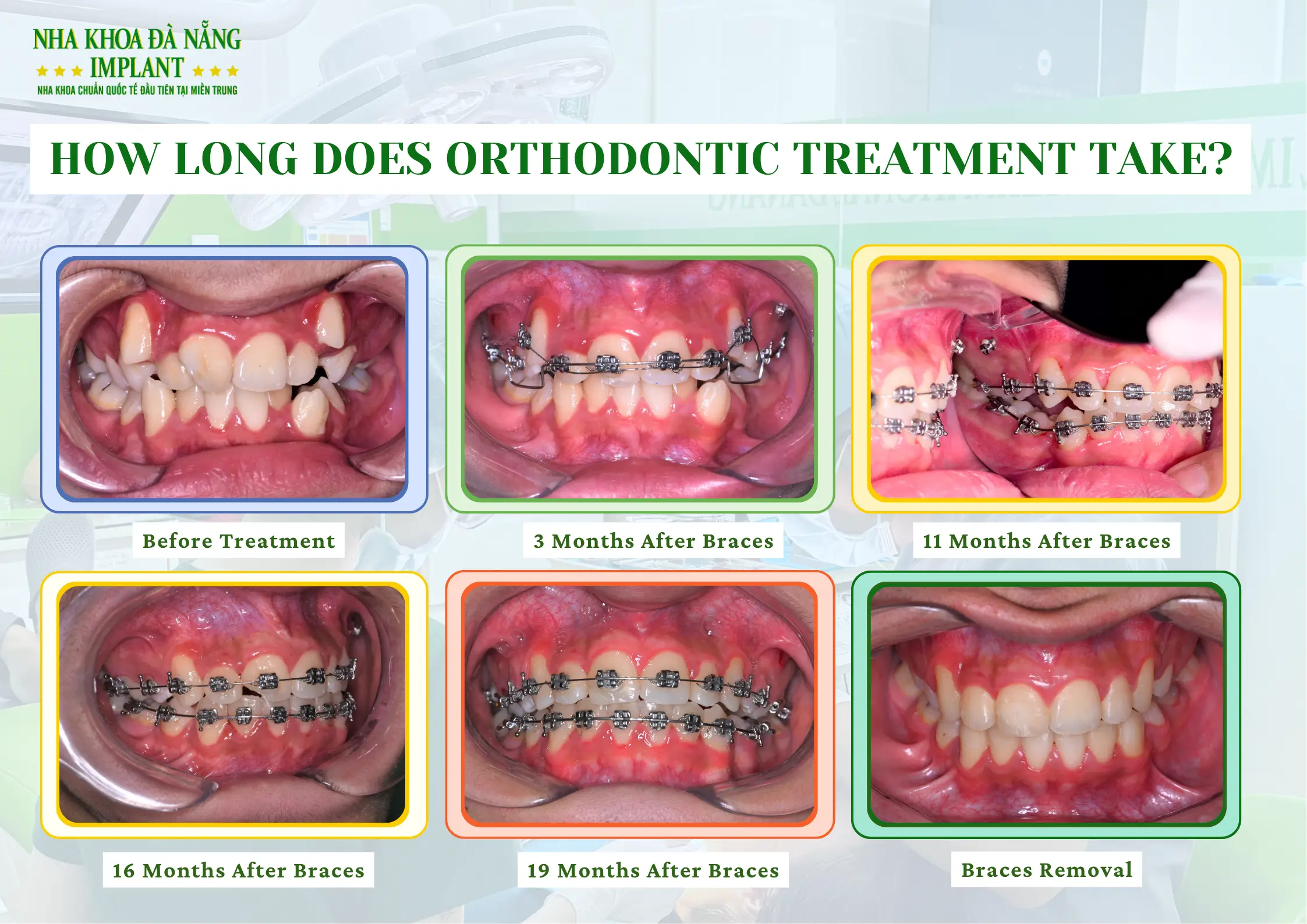 5 Biggest Fears When Getting Braces – How Dentists Help You Overcome Them 8 How Long Does Braces Treatment Take?