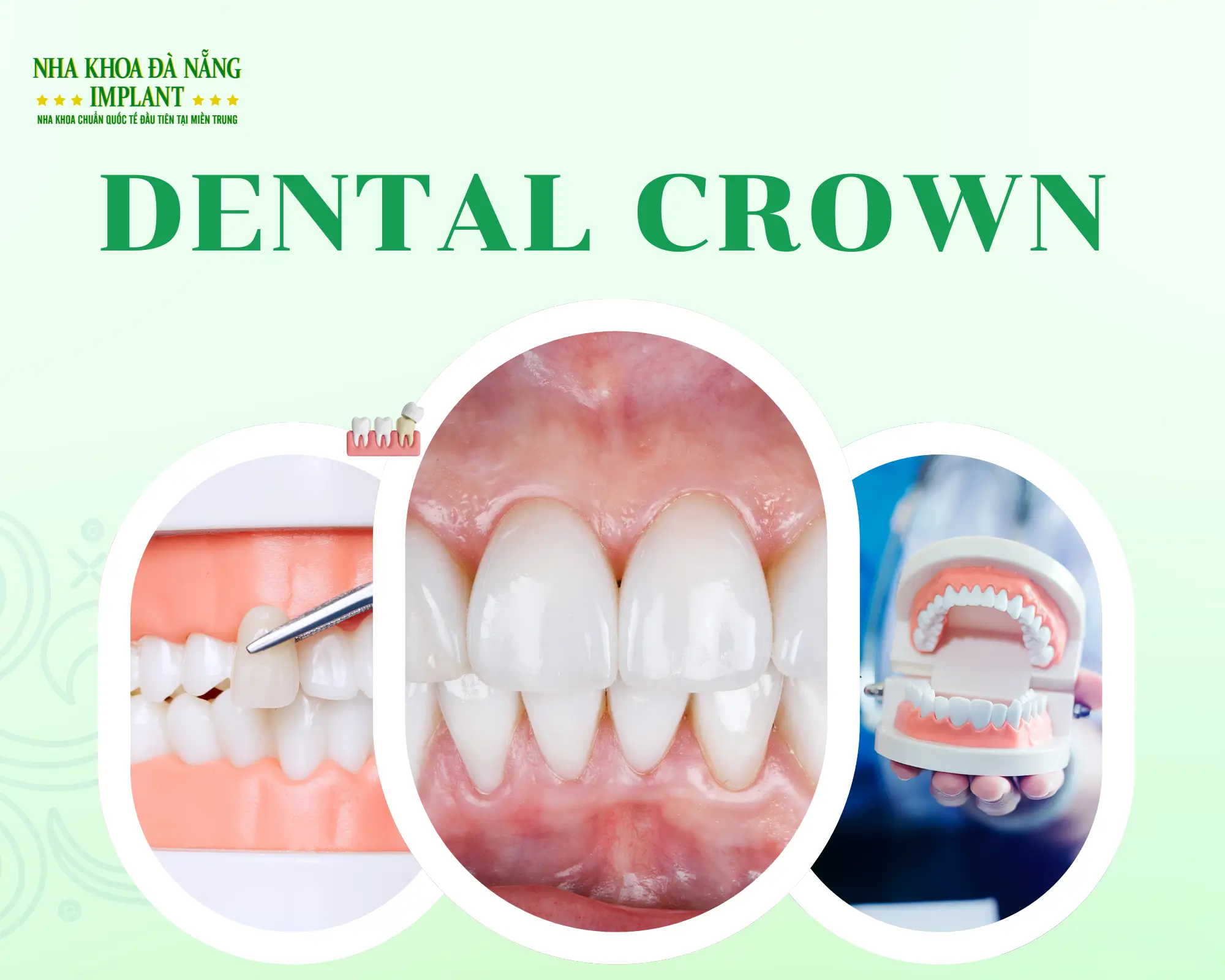 How to choose the right dental crown: Korea, Emax, Lisi Press, or Lava – which is the best?