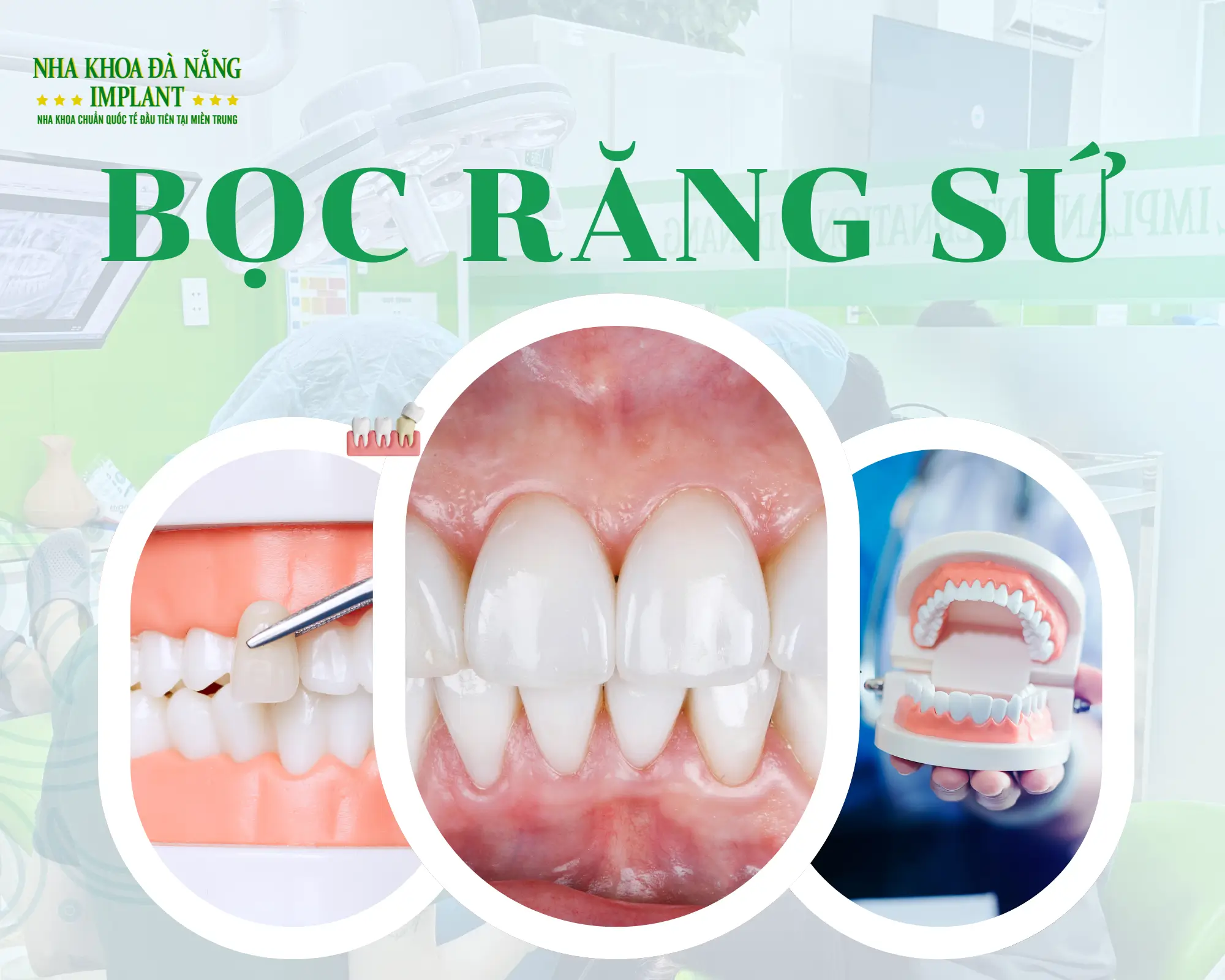 Kinh nghiệm chọn loại răng sứ: Korea, Emax, Lisi Press, Lava – loại nào tốt?