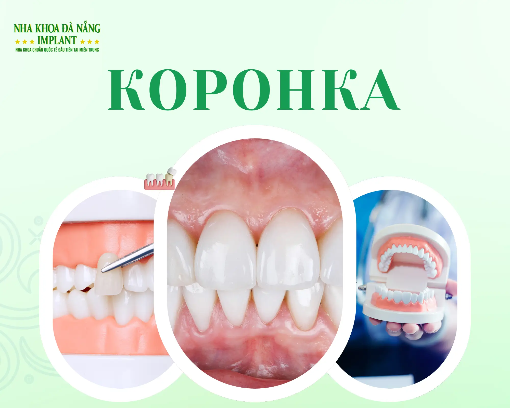 Как выбрать коронку: Korea, Emax, Lisi Press или Lava – какая лучше?