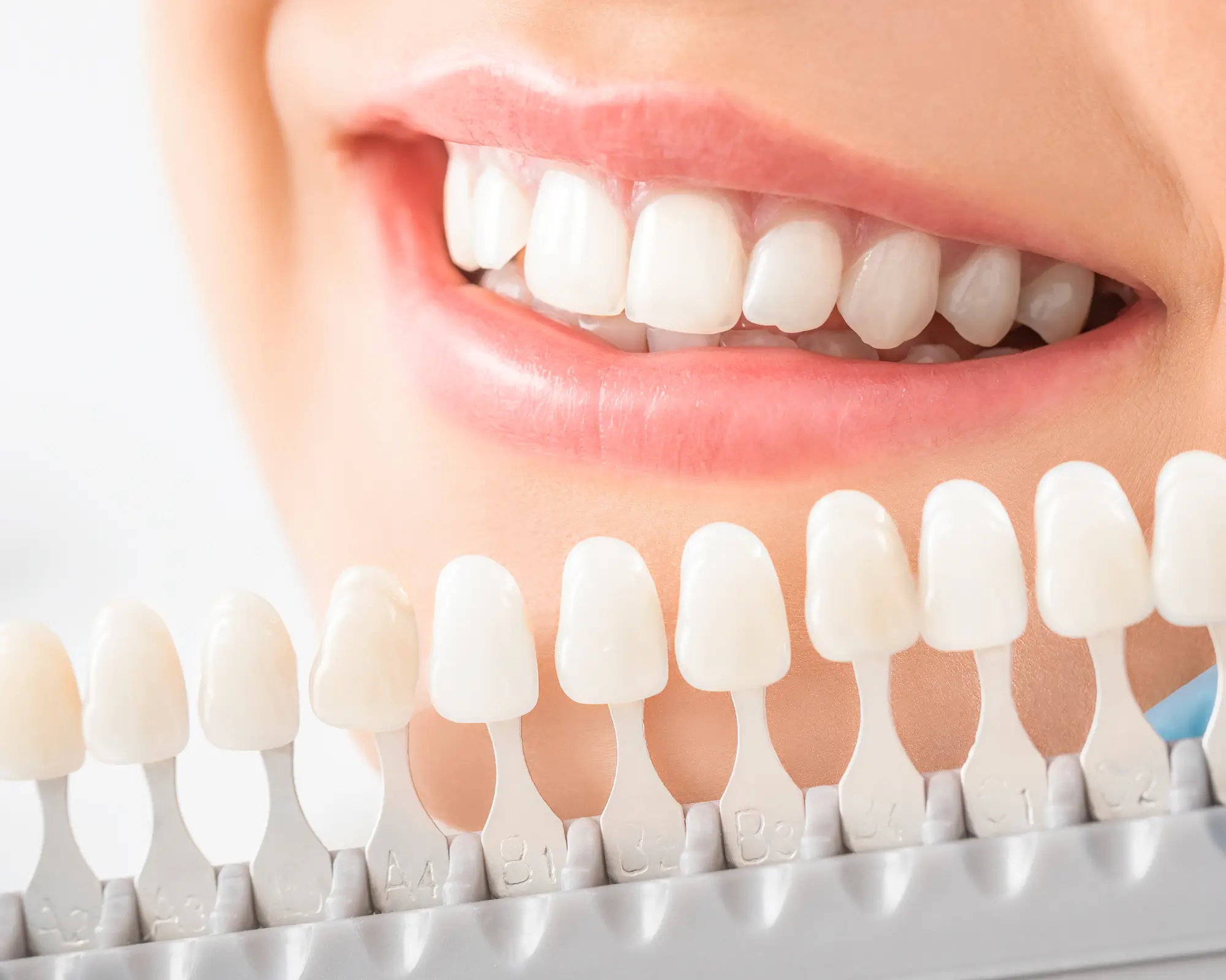 Kinh nghiệm chọn loại răng sứ: Korea, Emax, Lisi Press, Lava – loại nào tốt? 10 Kinh nghiệm chọn loại răng sứ: Korea, Emax, Lisi Press, Lava – loại nào tốt?