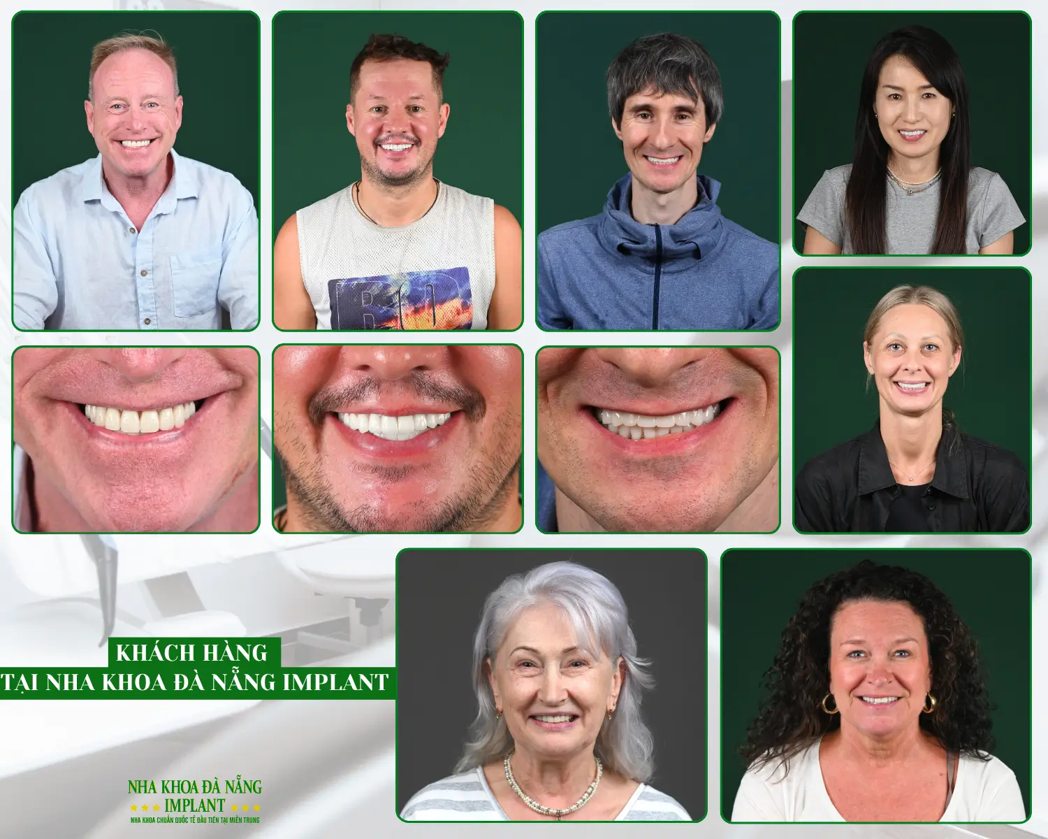 5 Lý Do Khách Nước Ngoài Chọn Cấy Implant Tại Nha Khoa Đà Nẵng Implant 10 Kết quả thực tế từ khách hàng quốc tế – răng chắc khỏe, thẩm mỹ tự nhiên, nụ cười tự tin