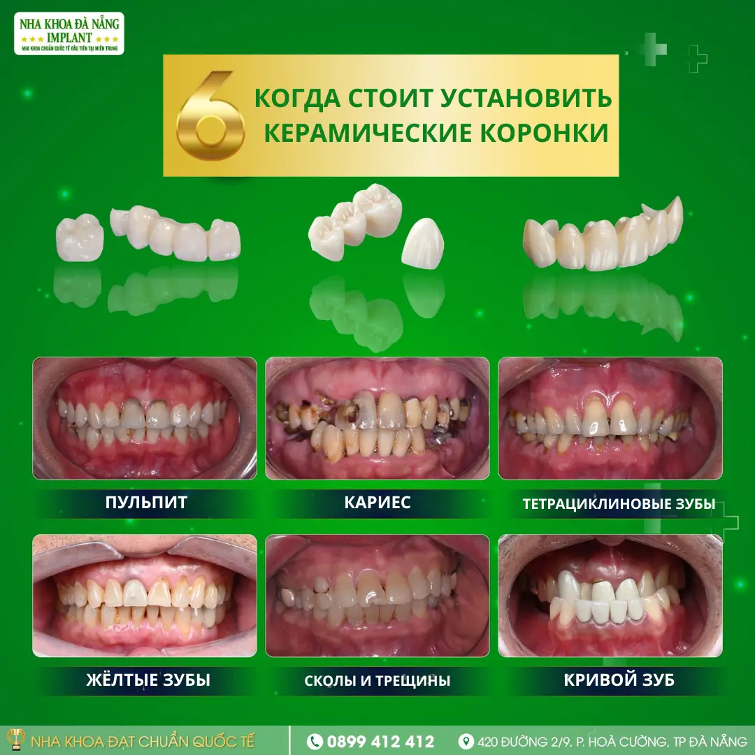 6 случаев, когда рекомендуется установка керамических коронок - идеальное решение для уверенной улыбки