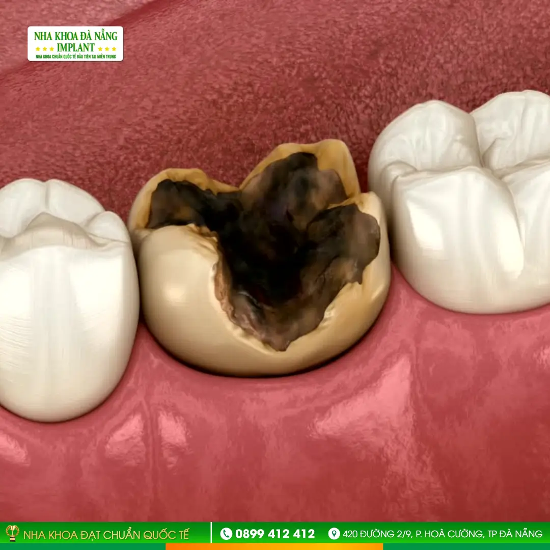 Large Cavity / Severe Tooth Decay