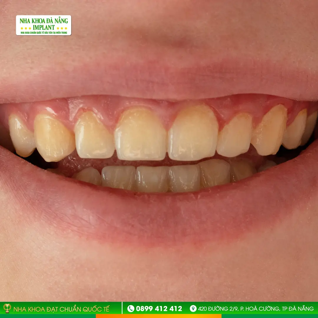 Yellowed or Long-Term Stained Teeth