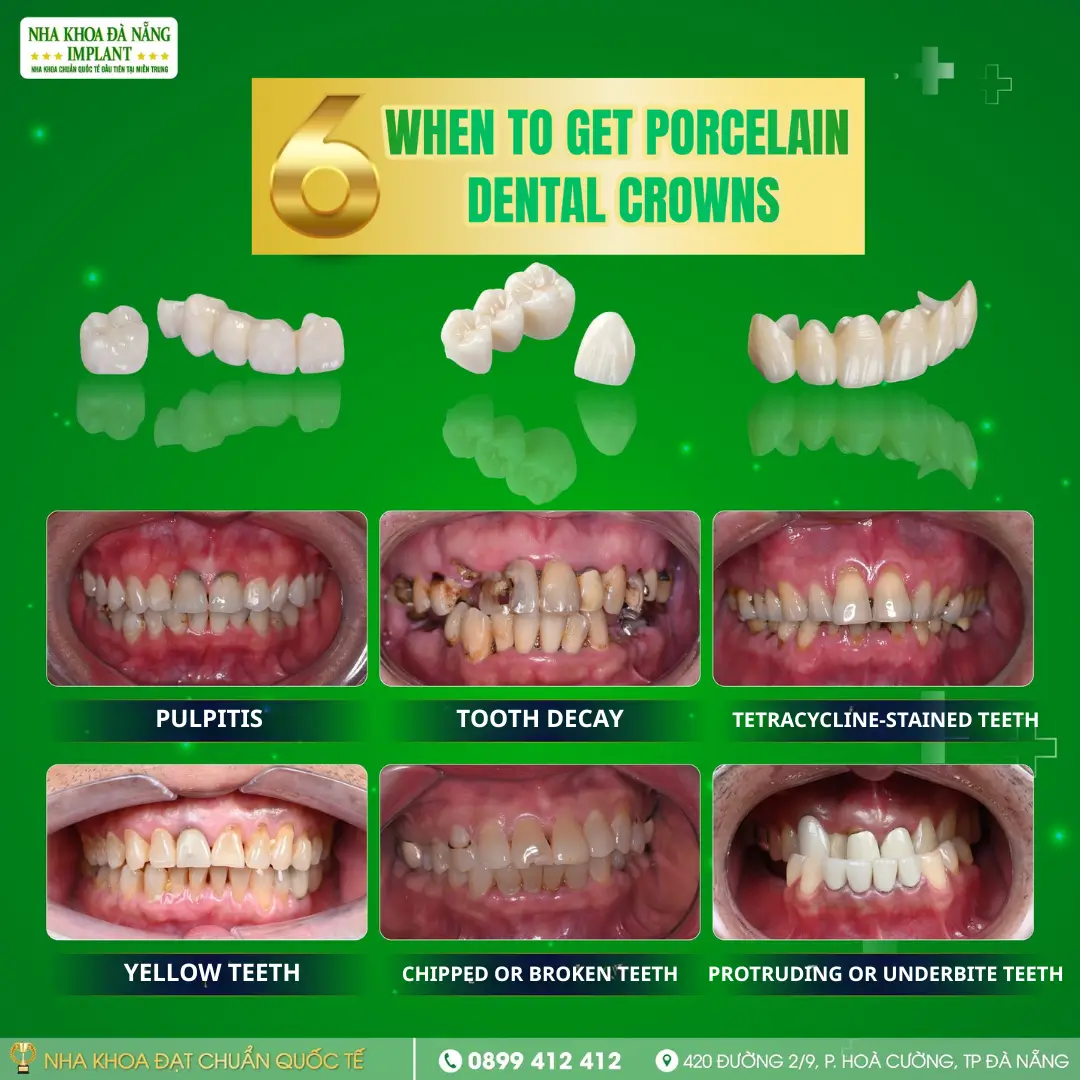 6 Cases When Porcelain Dental Crowns Are Recommended – The Perfect Solution for a Confident Smile