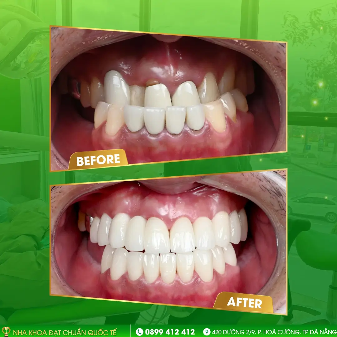 Porcelain crowns help correct mild protruding or underbite teeth.