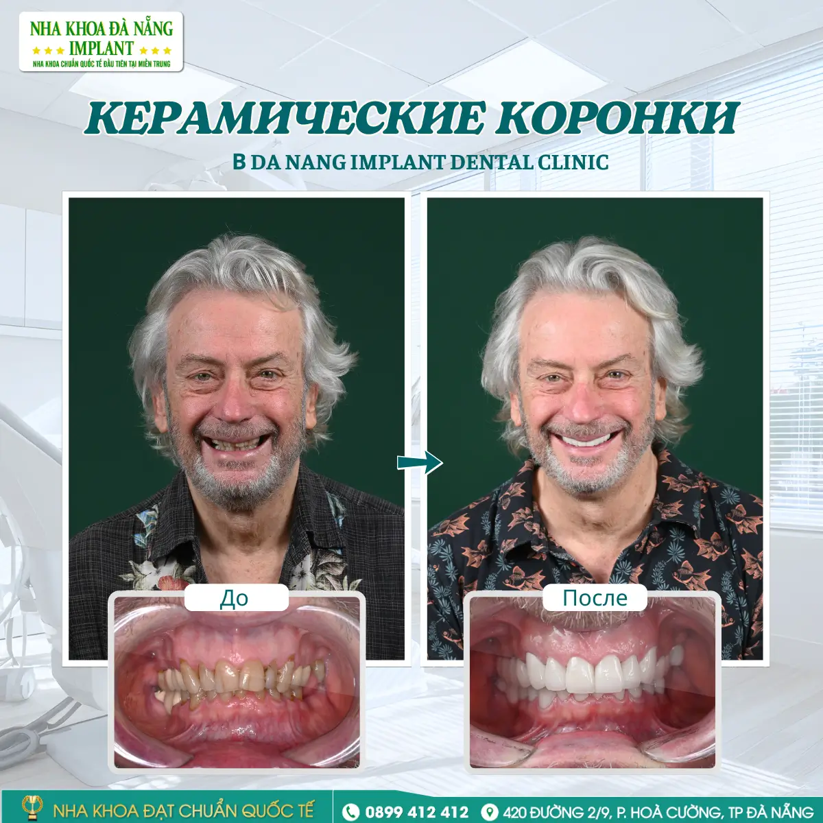 Клиент: MARK HILTON – Лечение: цельнокерамические коронки Lava