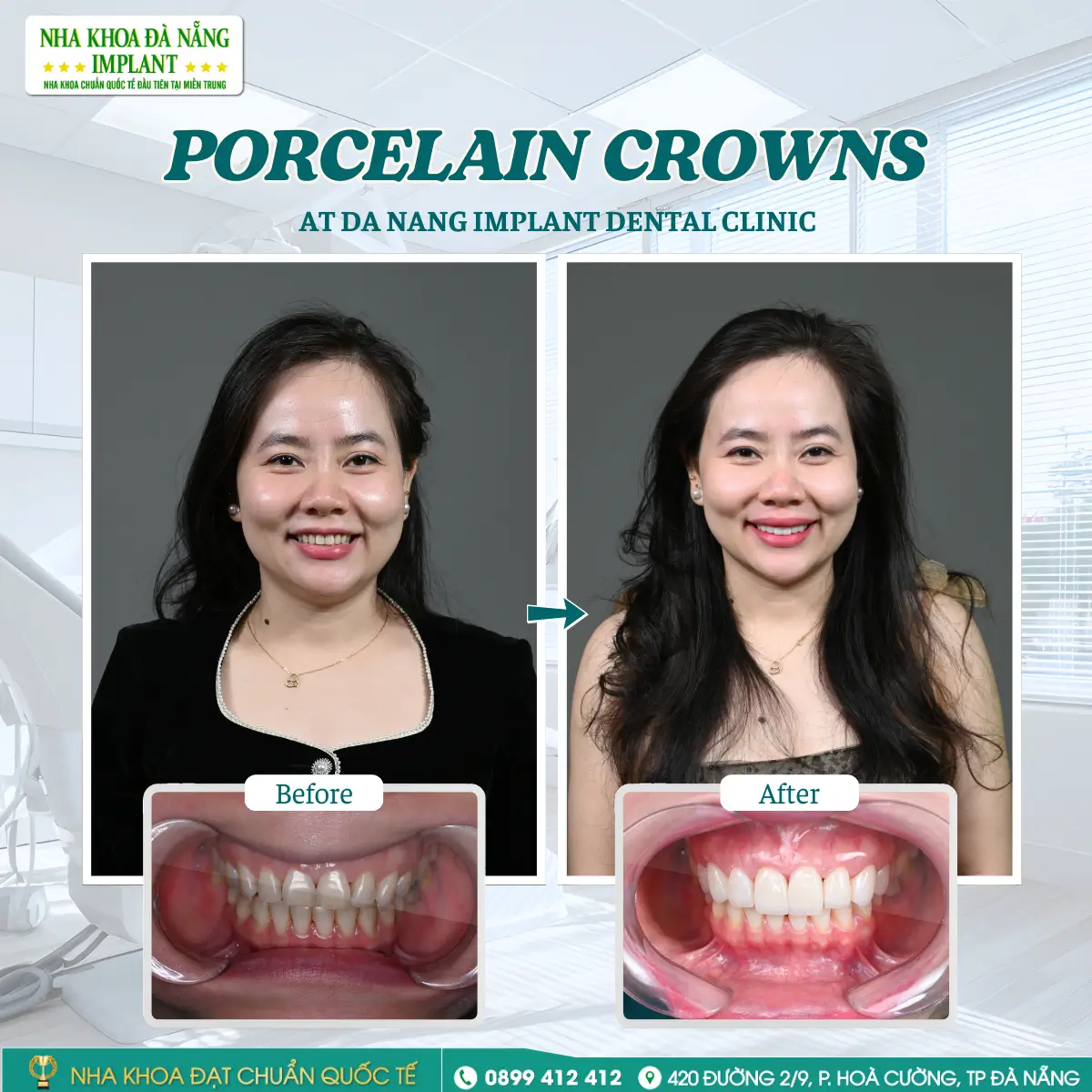 Customer: Thai Hong Viet – Treatment: Lisi Press Veneer