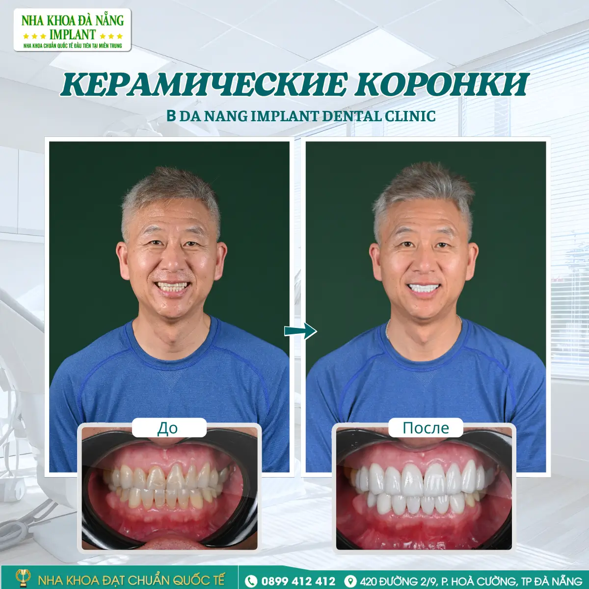 Клиент: Брайан Ким – Лечение: Виниры Lisi Press