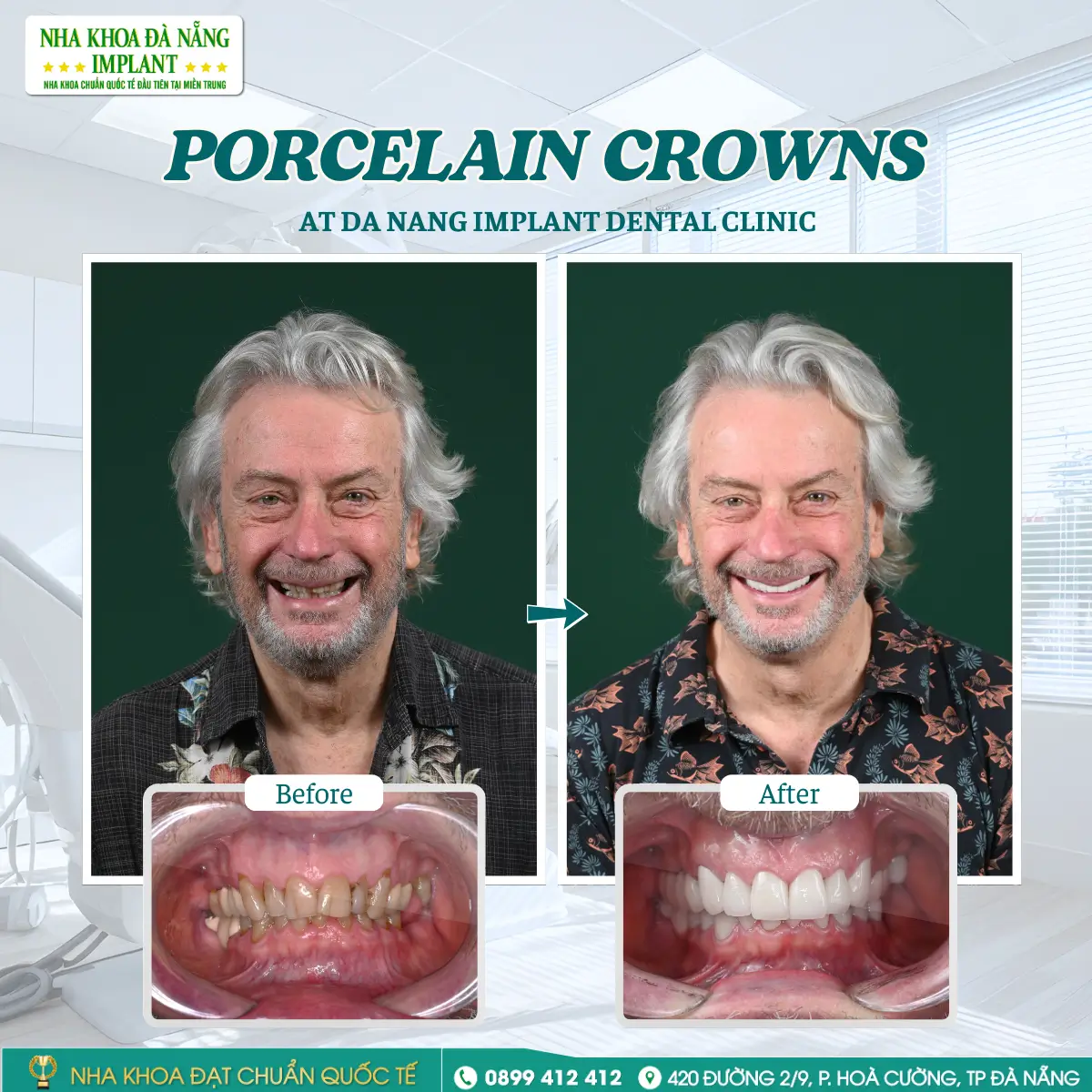 Customer: MARK HILTON – Treatment: Lava all-ceramic crowns