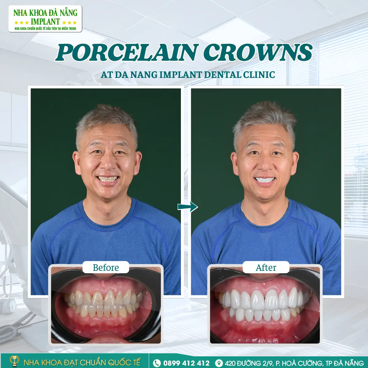 Customer: Brian Kim – Treatment: Lisi Press Veneer