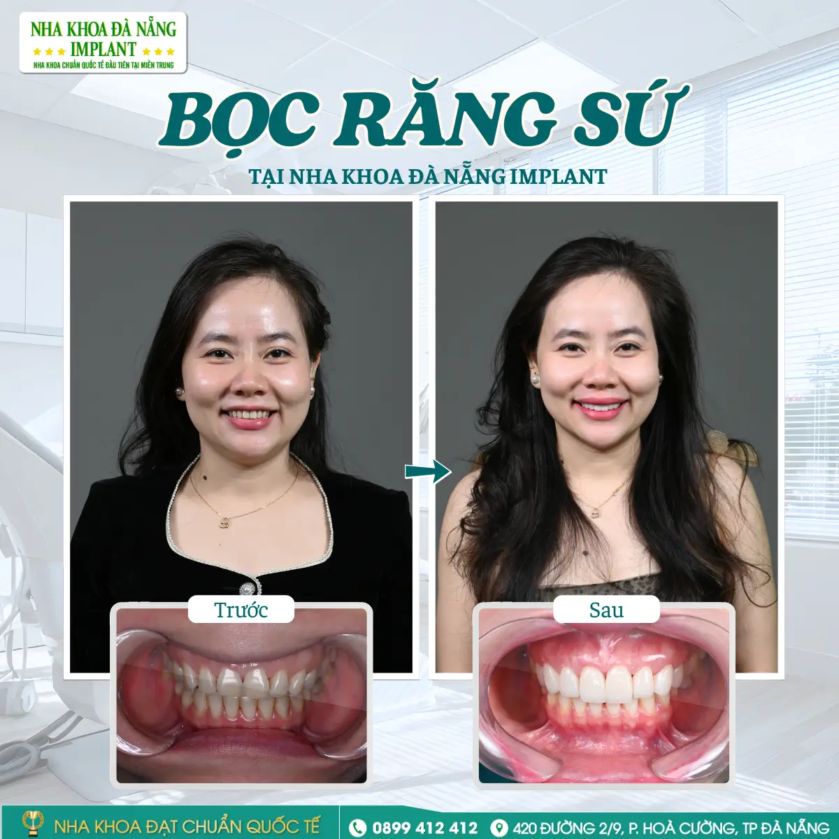 Khách hàng: Thái Hồng Việt - Điều trị: Mặt dán sứ Veneer Lisi Press