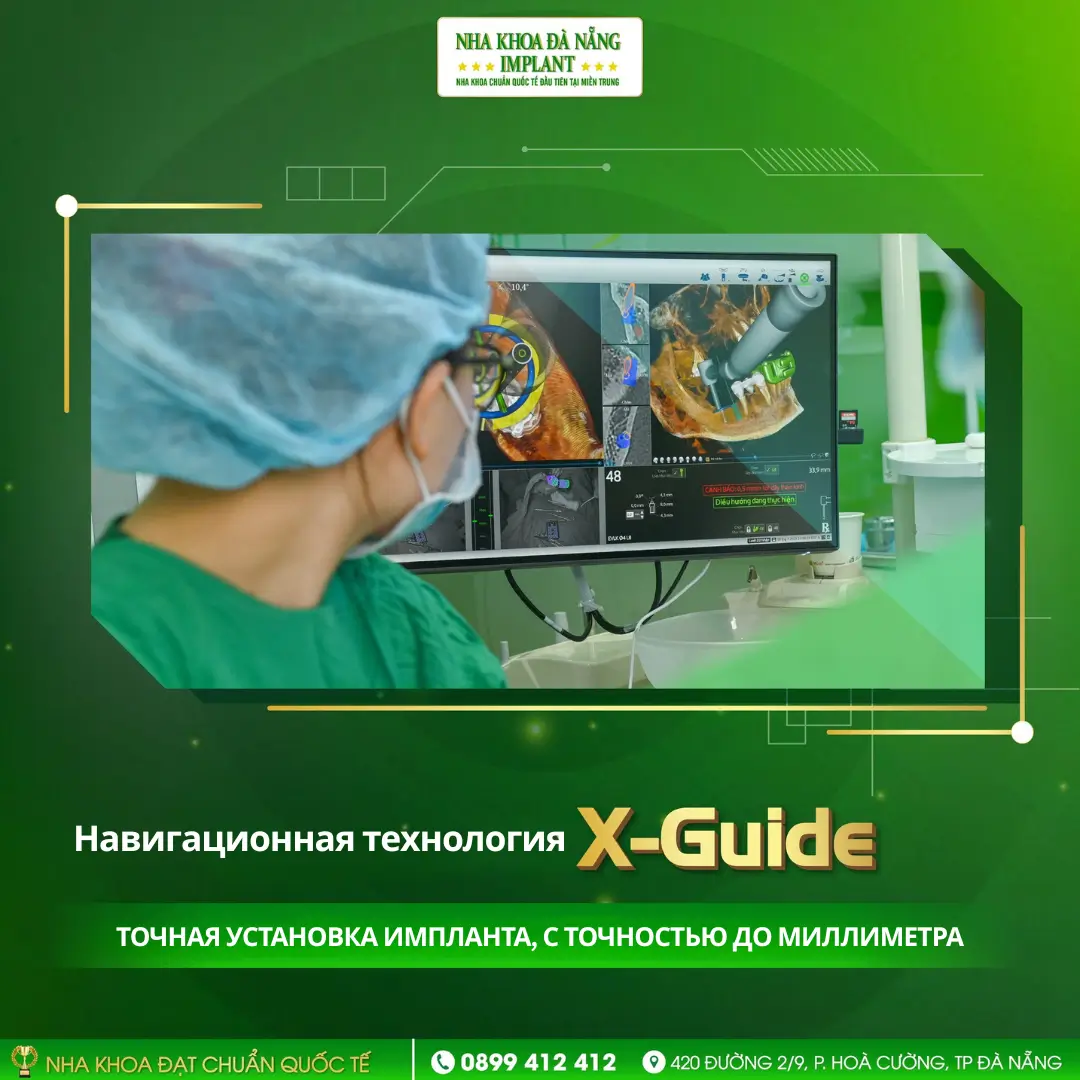 Технология X-Guide – точная установка импланта с миллиметровой точностью