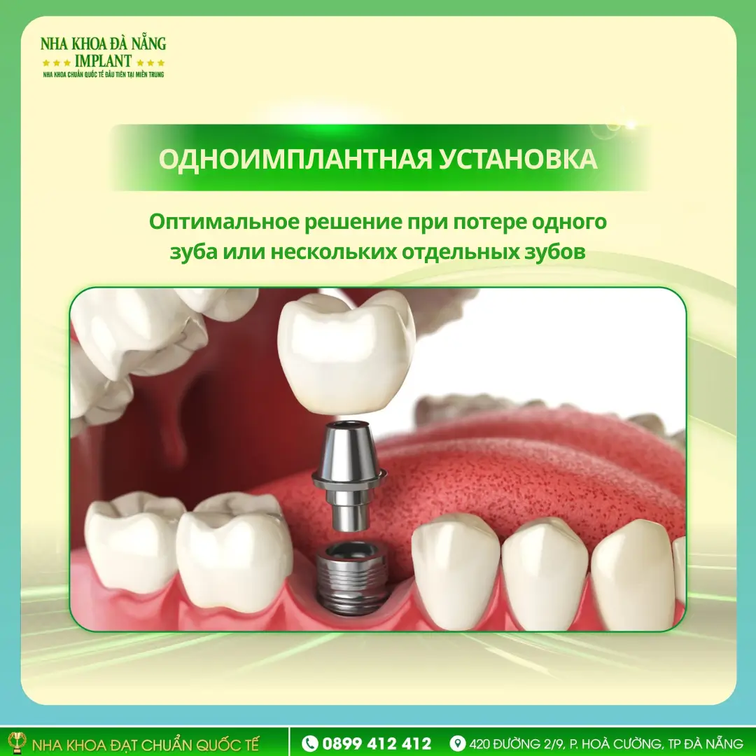 Одноимплантная установка