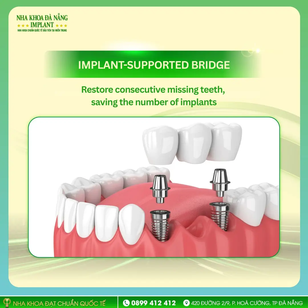 Implant-Supported Bridge