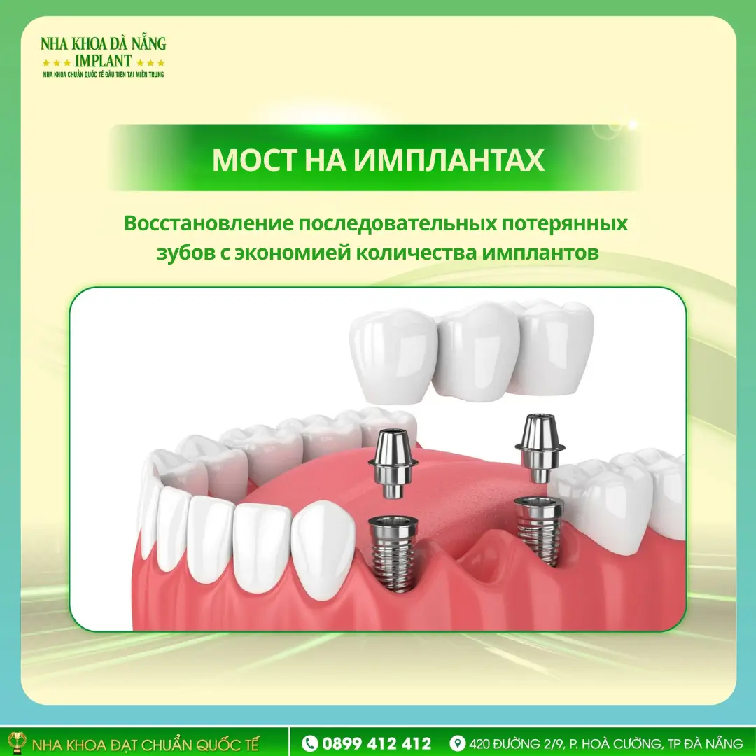 Мост на имплантах