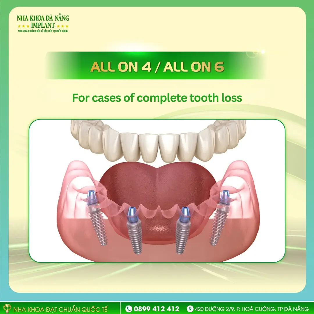 Full-Arch Restoration All-on-4 / All-on-6