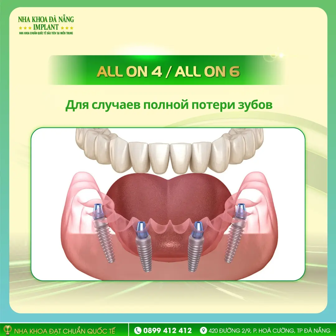 Полное восстановление зубов All-on-4 / All-on-6