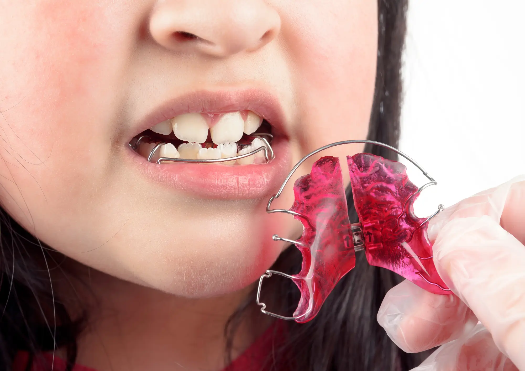 Hàm duy trì tháo lắp 