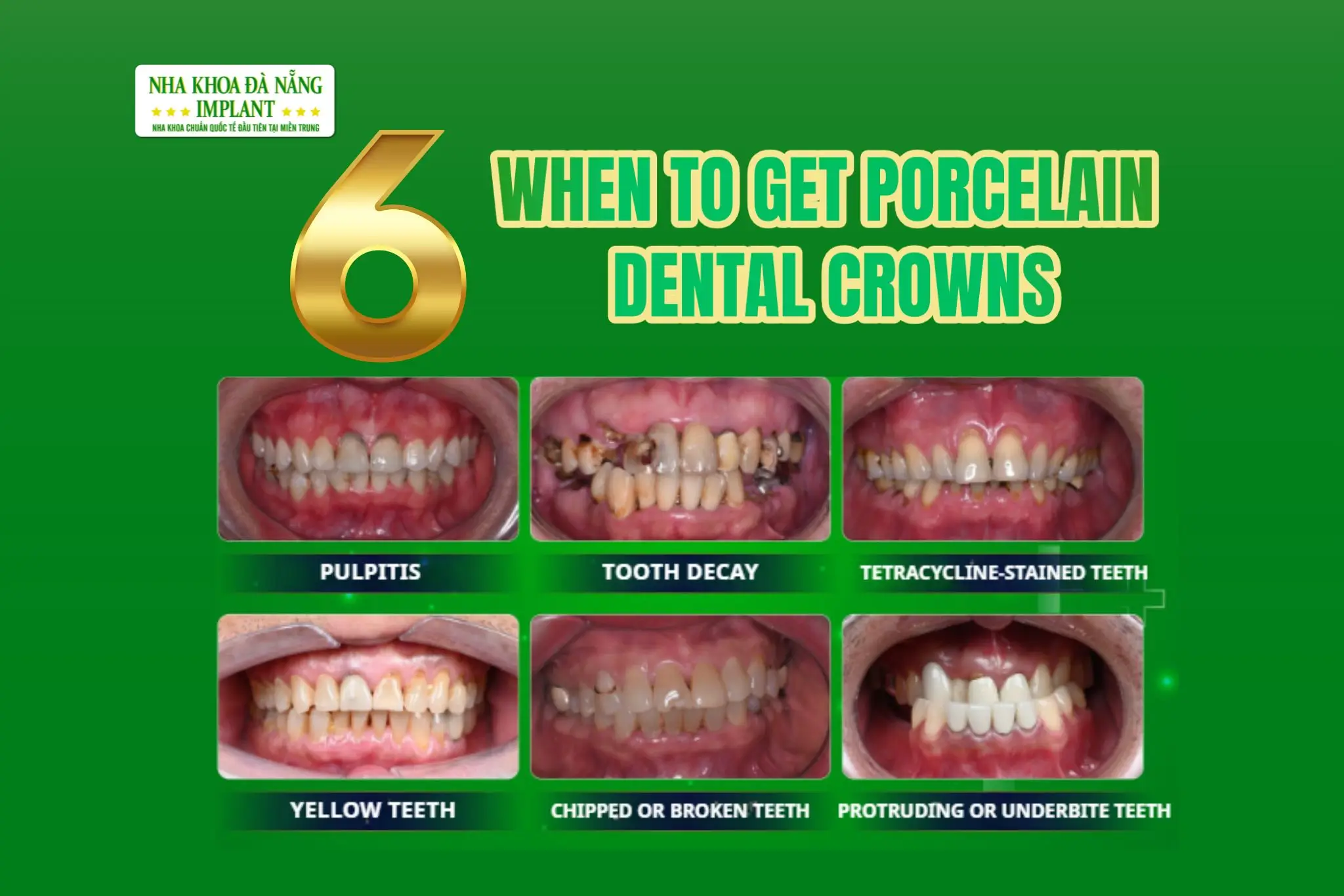 6 Cases When Porcelain Dental Crowns Are Recommended – The Perfect Solution for a Confident Smile