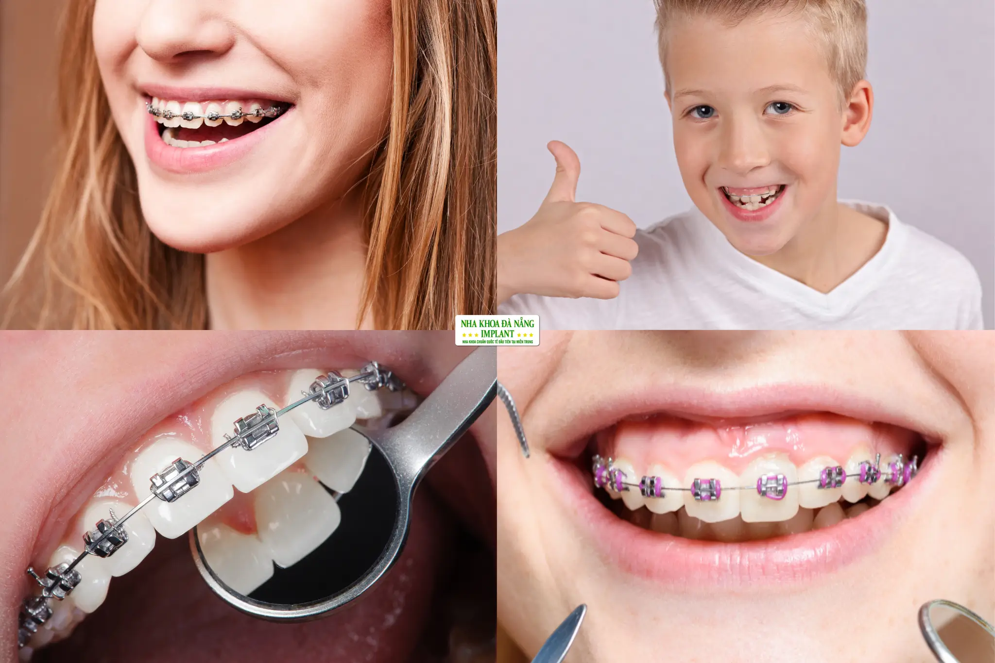 Niềng Răng Người Trưởng Thành Khác Gì Niềng Răng Tuổi Teen?