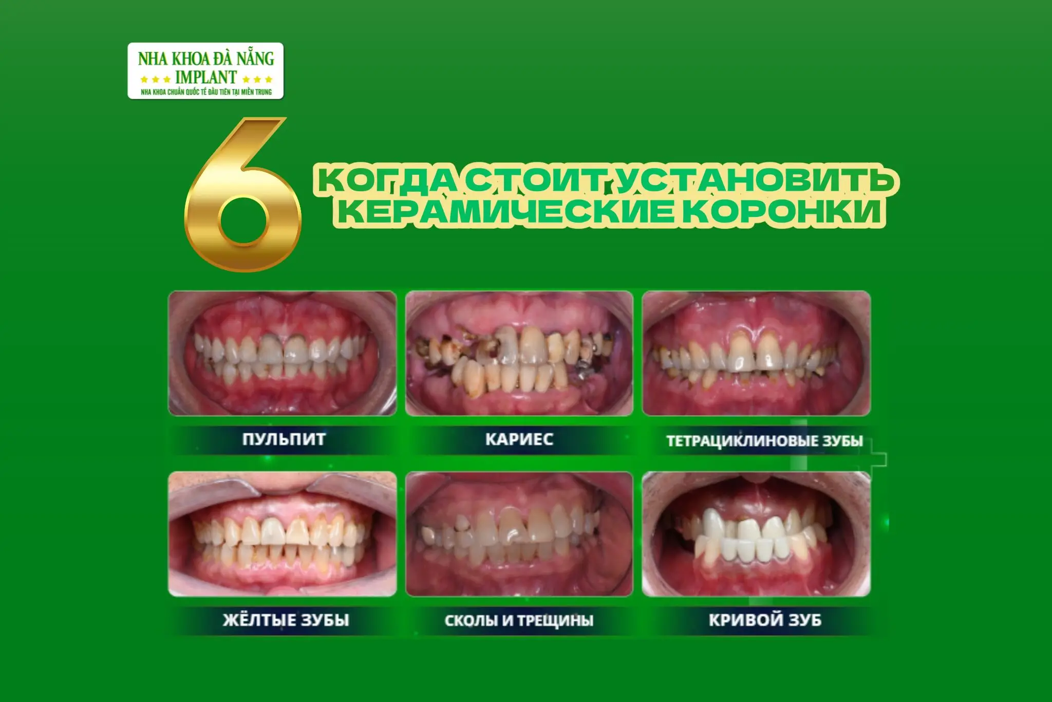 6 случаев когда рекомендуется установка керамических коронок - идеальное решение для уверенной улыбки