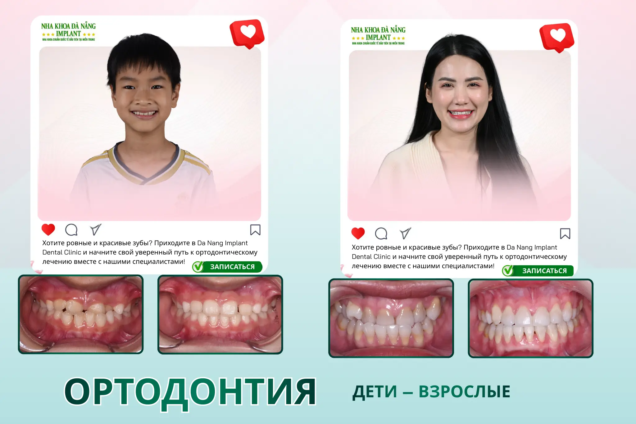 Ортодонтическое лечение в Da Nang Implant Dental Clinic