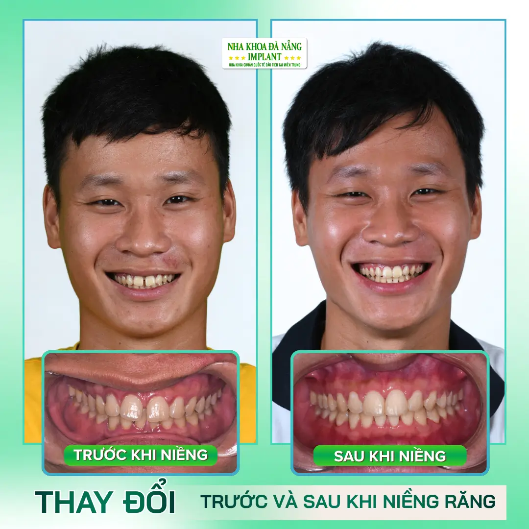 Hình Ảnh Thực Tế: Trước – Sau Niềng Răng