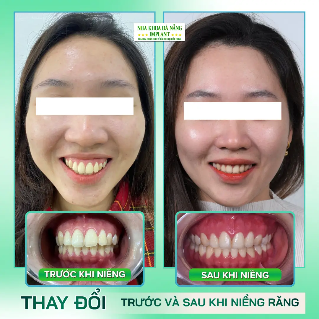 Hình Ảnh Thực Tế: Trước – Sau Niềng Răng