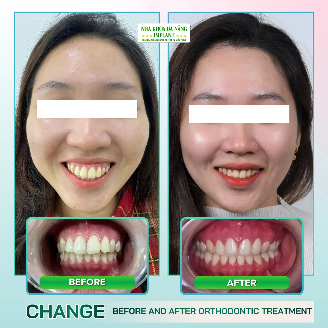 Real Images: Before – After Braces