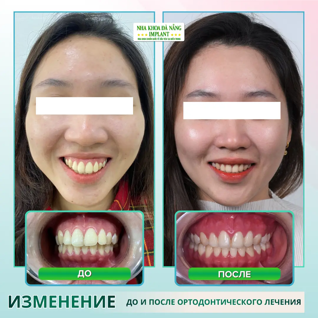 Реальные фотографии: До – После брекетов