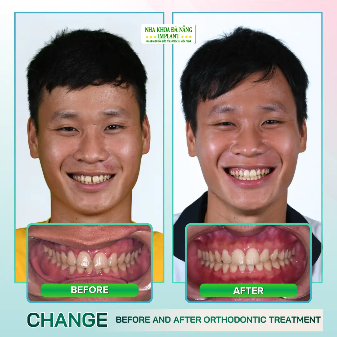 Real Images: Before – After Braces