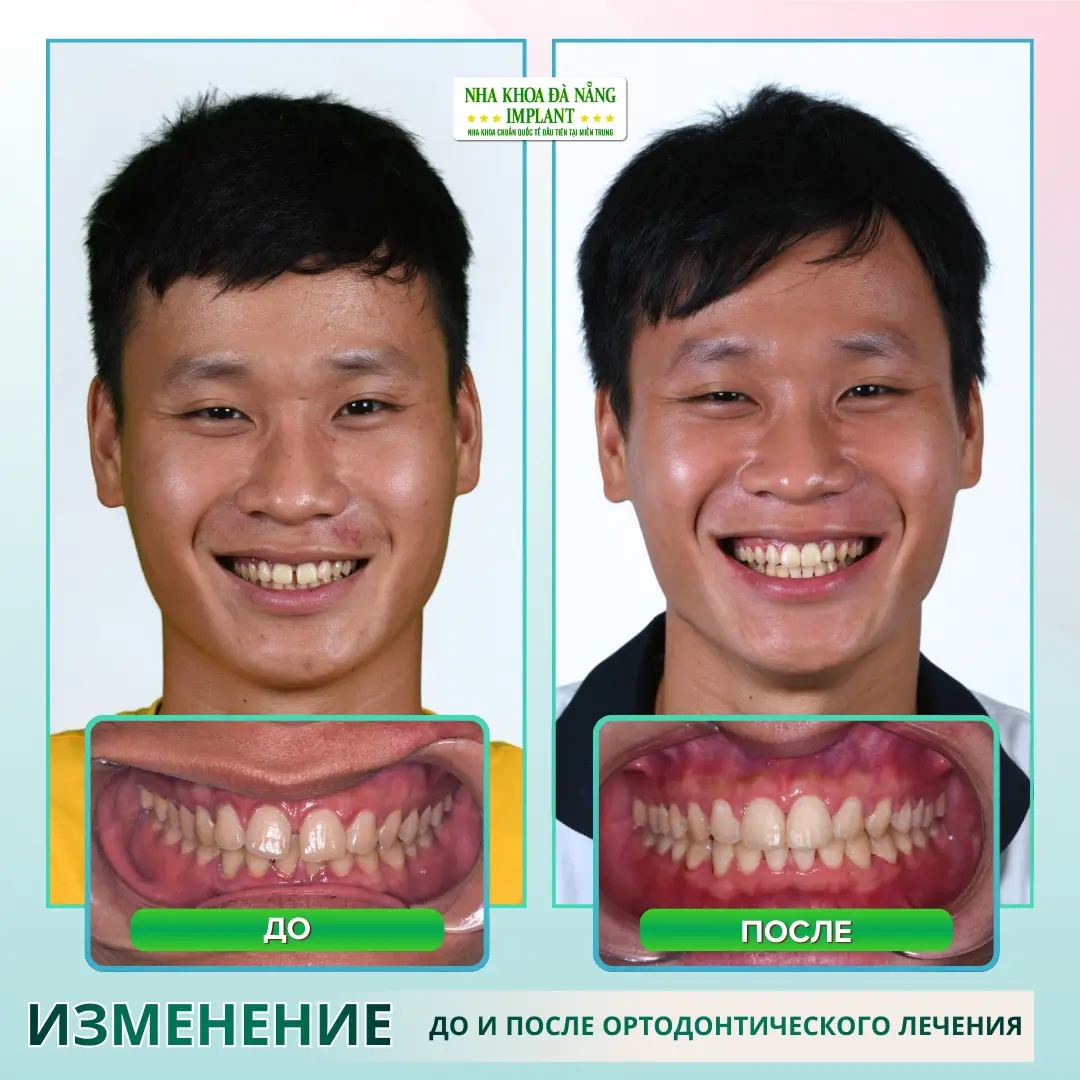 Реальные фотографии: До – После брекетов