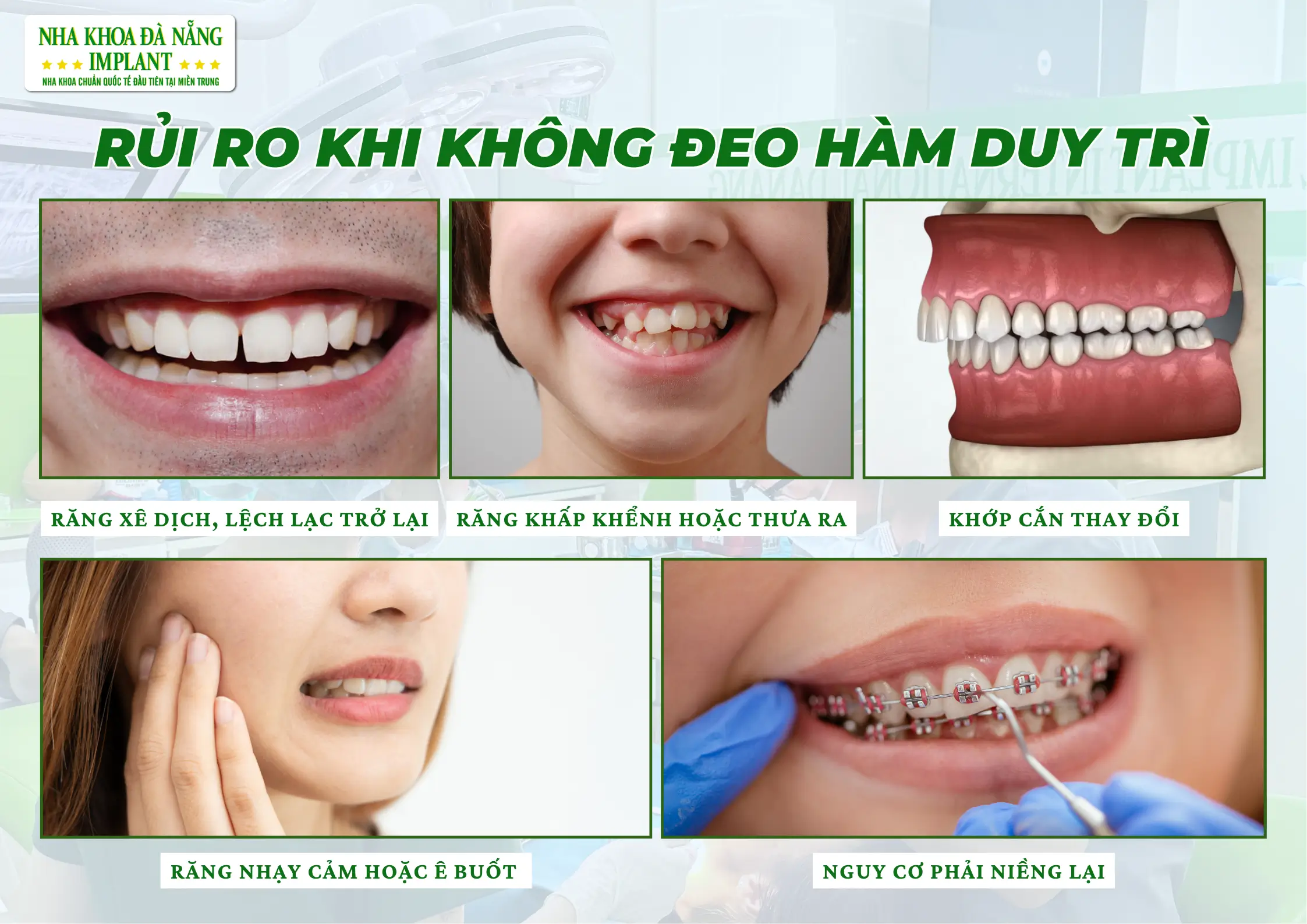 Hậu quả nếu không đeo hàm duy trì