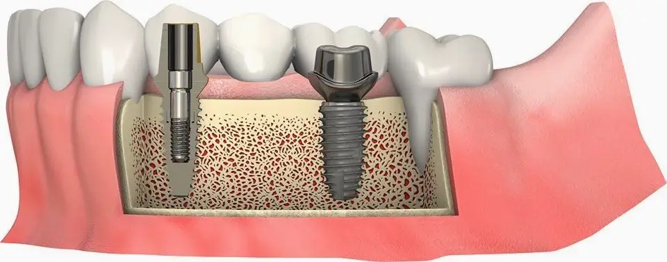 Vì sao cần ghép xương hoặc nâng xoang khi trồng Implant?