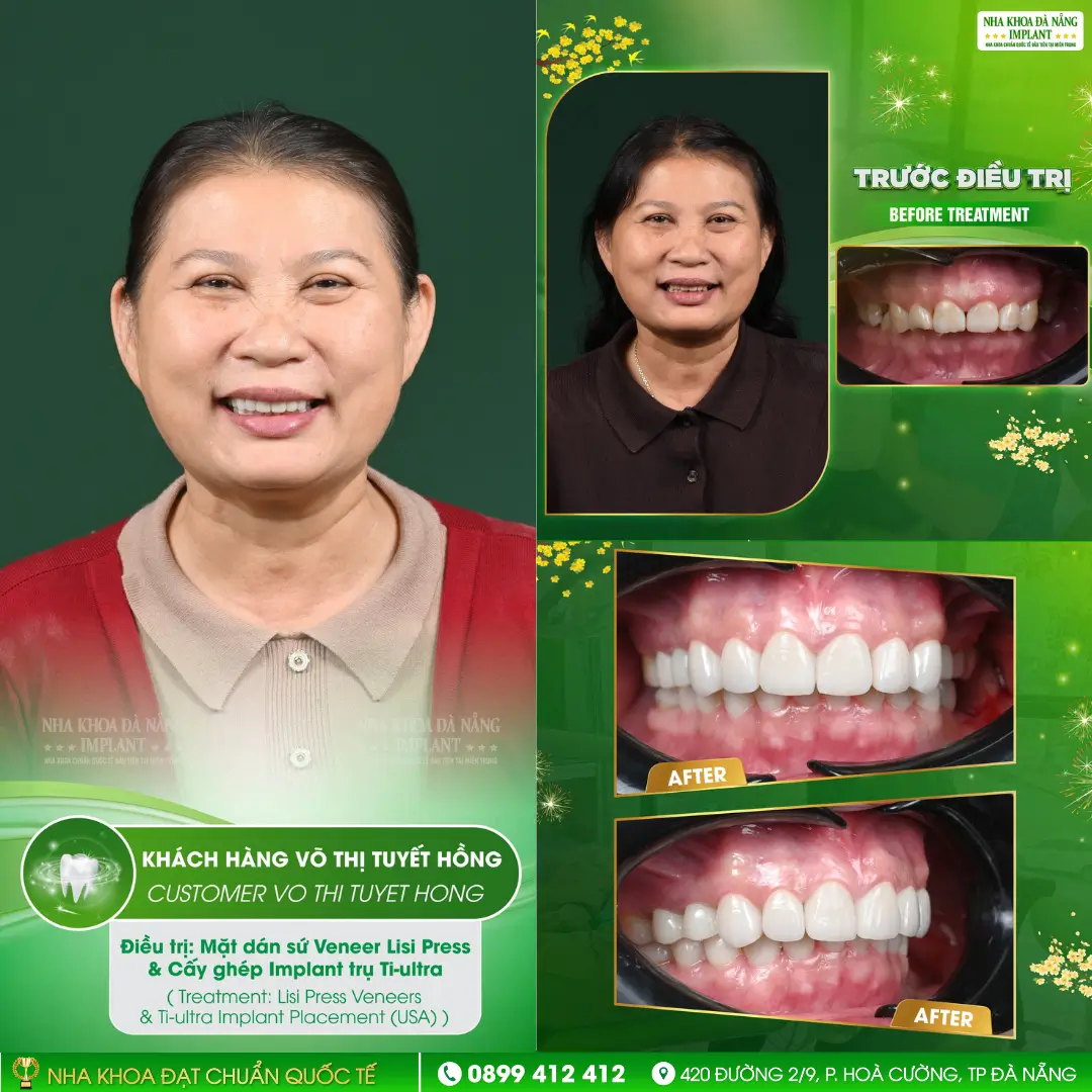 Can You Get Porcelain Dental Crowns in Time for Tet?