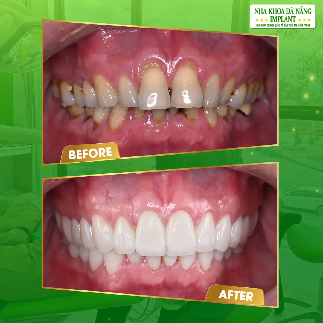 Làm Răng Đón Tết: Nên Chọn Giải Pháp Nào Để Kịp Thời Gian? 10 Bọc Răng Sứ – Giải Pháp Thẩm Mỹ Toàn Diện